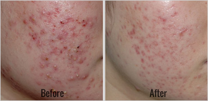 Spectra-Laser-Peel-Before-After-2