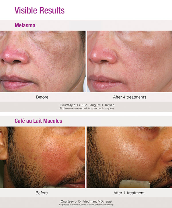 NA-EB-2023-03-08-PicoWay-Melasma-FacingMelasma-02